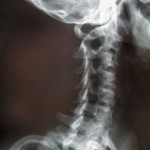 Davenport Chiropractic neck x-ray